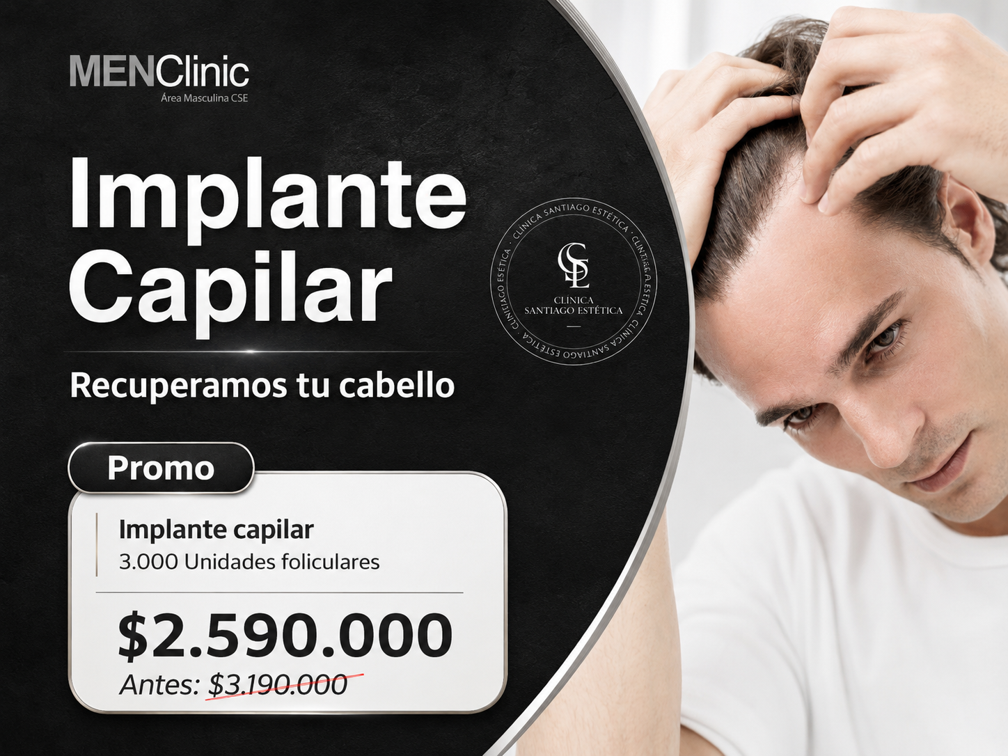 Implante capilar técnica FUE en MenClinic Santiago